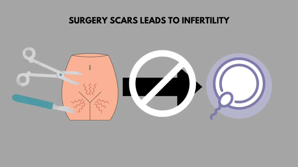 Infertility from Surgery Scars